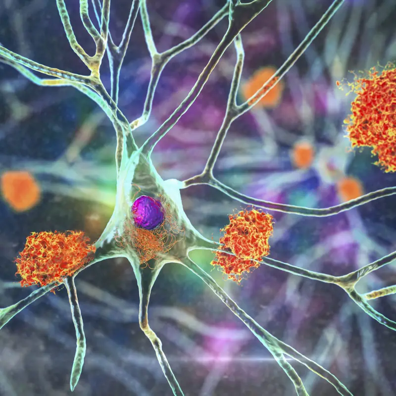 Болезнь Альцгеймера может быть вызвана иммунной системой: почему-то защита организма начинает путать клетки мозга с чужеродными бактериями