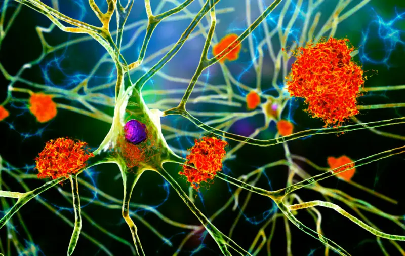 Существует возможная связь между грибковыми инфекциями головного мозга и развитием болезни Альцгеймера
