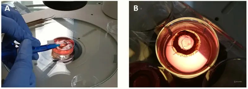 Инновационная 3D-печать поможет лечению катаракты и других заболеваний глаз